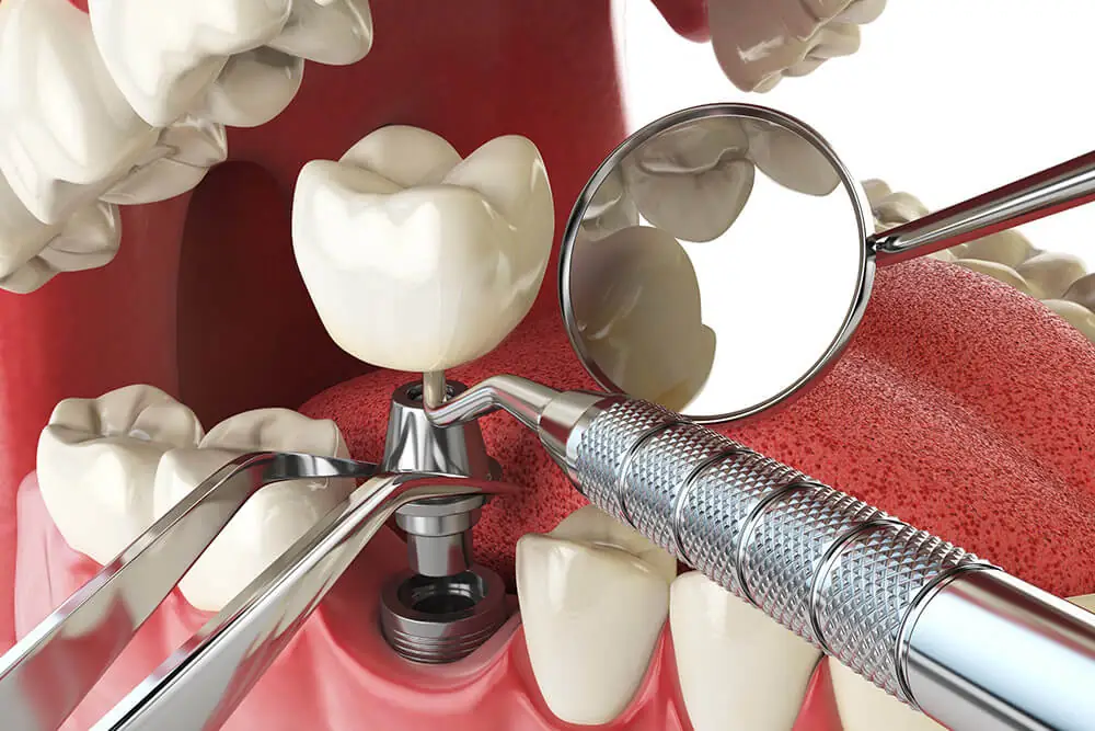 Dental Implants
