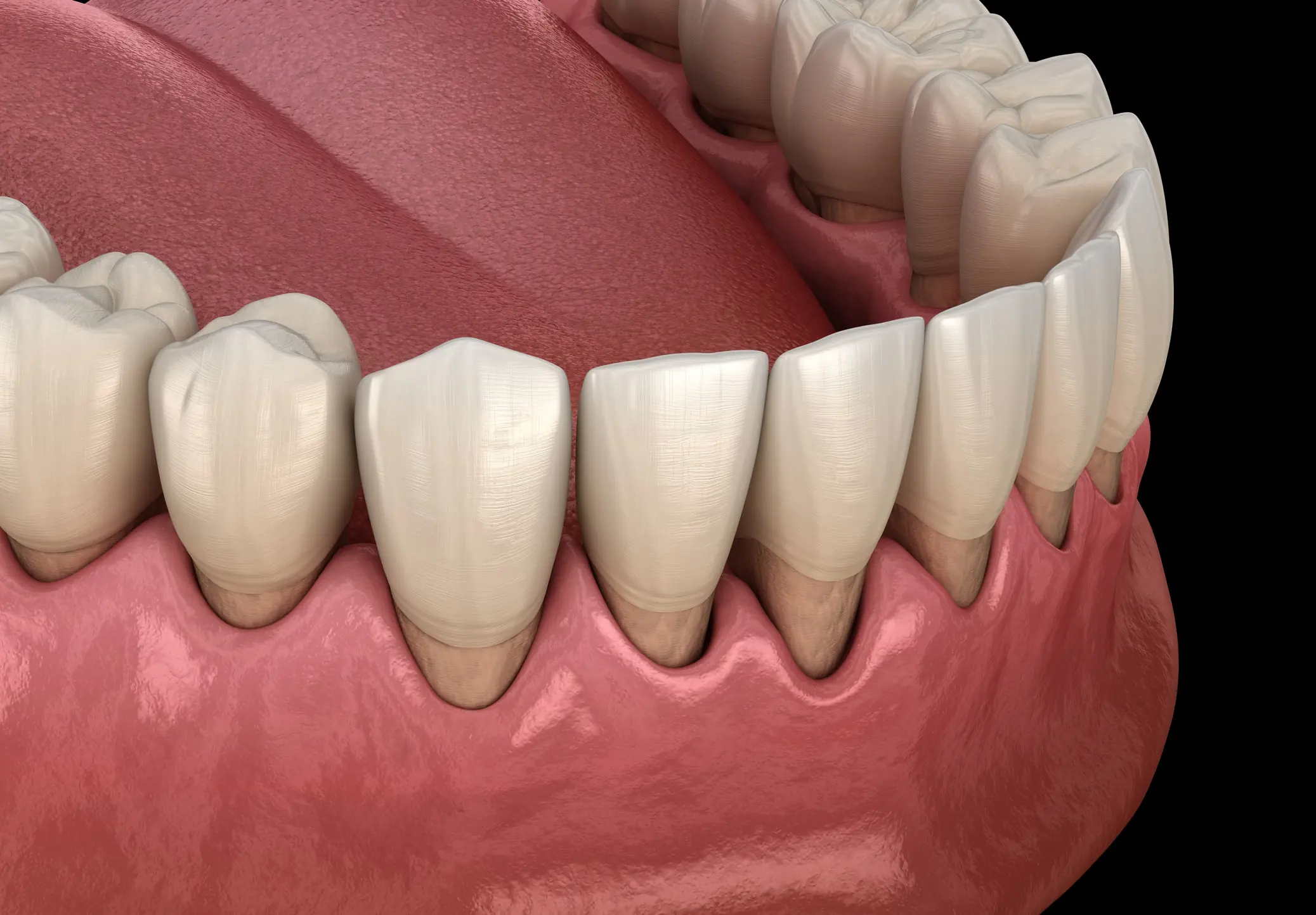 Gum Disease (Periodontal Disease)