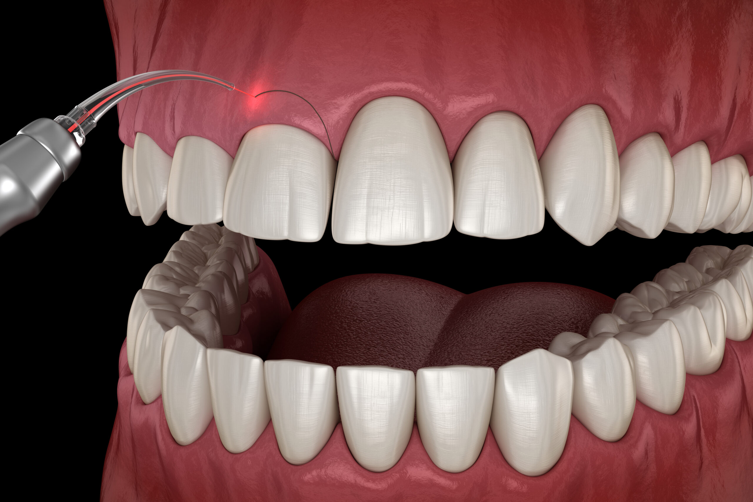 Gum Grafting