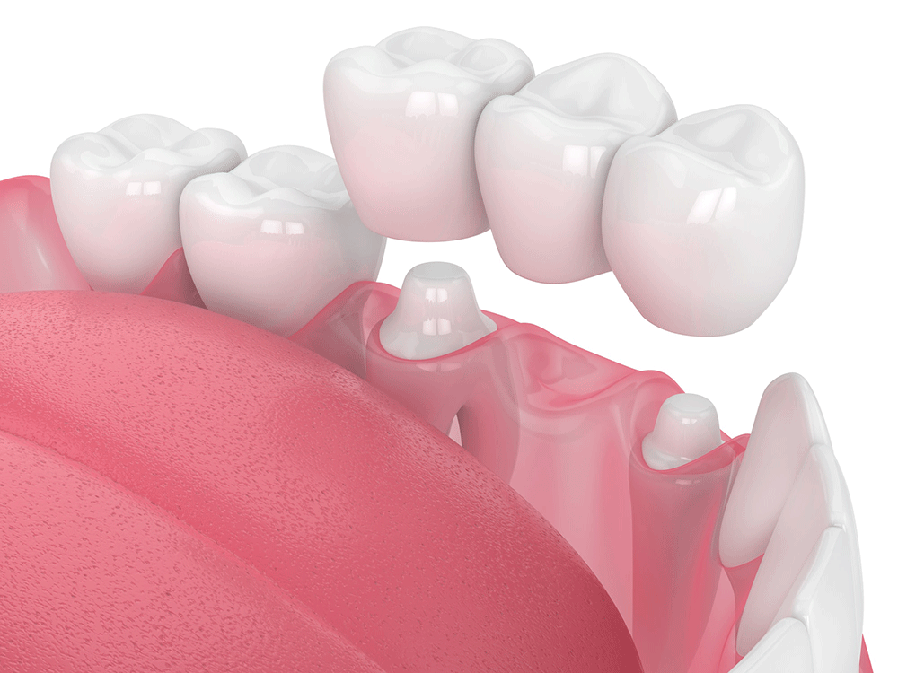 Dental Crowns & Bridges