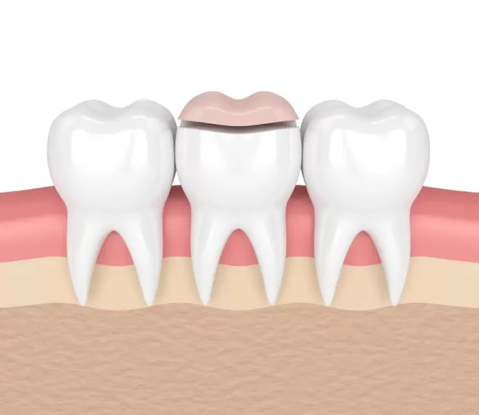 Dental Inlays & Onlays